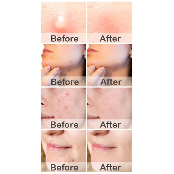 Brand new - pimple patches - Picture 4 of 7